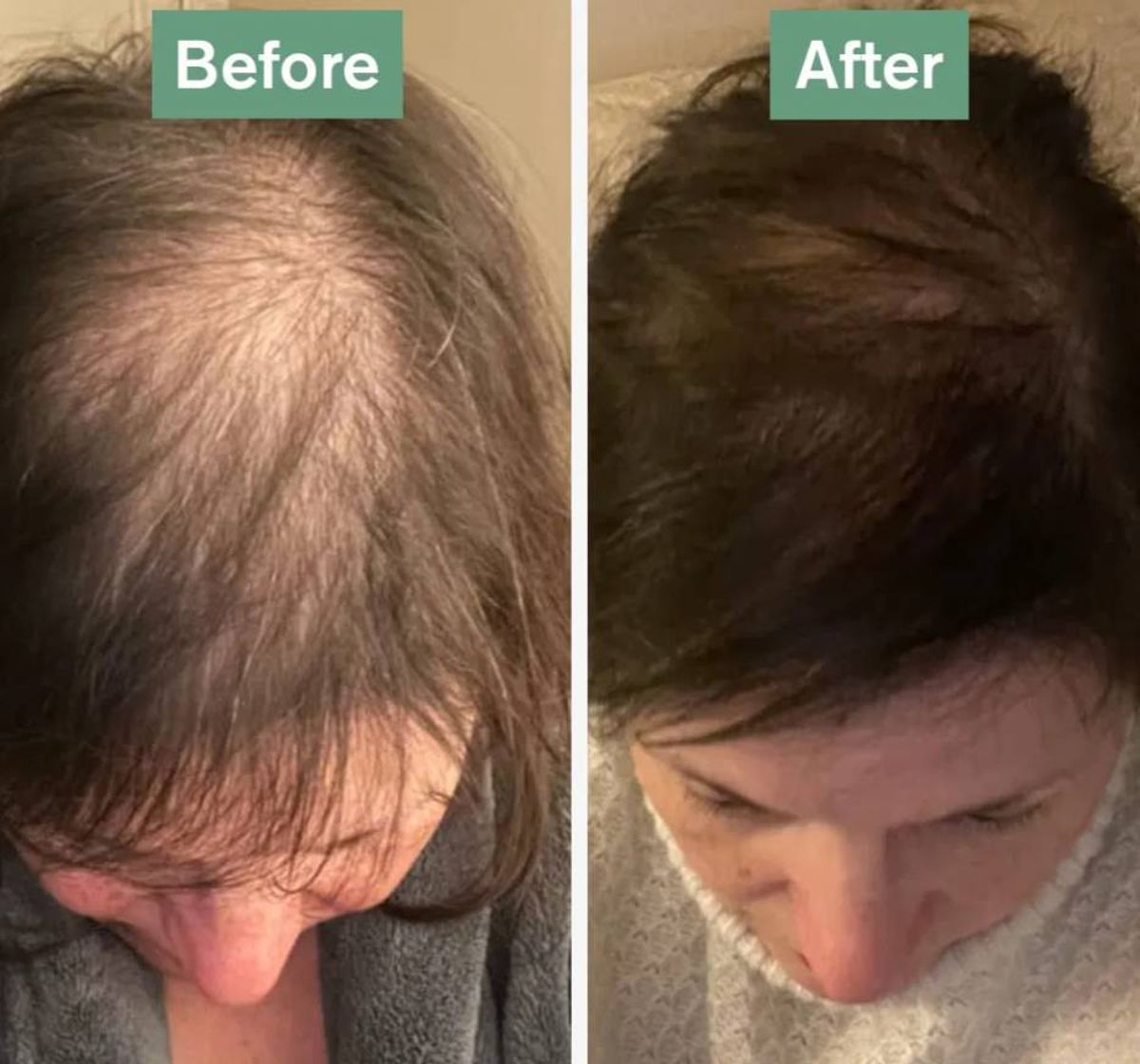 A comparison photo showing the improvement of hair condition before and after treatment. The left side shows a head with significant hair loss, while the right side shows a head with visibly fuller and healthier hair.