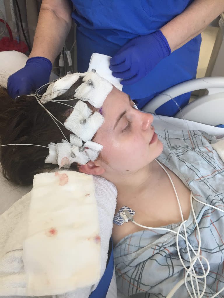 Hoffman used stereo electroencephalography to determine where her seizures began in the brain. By Ariel Hoffman