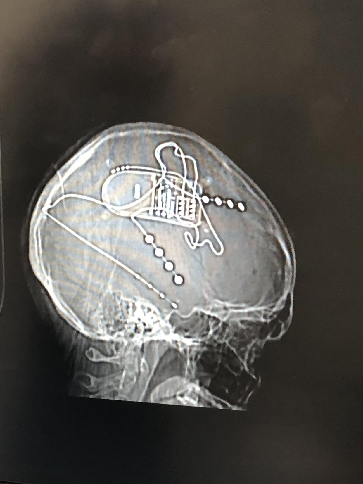 The device inside Hoffmann's brain. By Ariel Hoffman