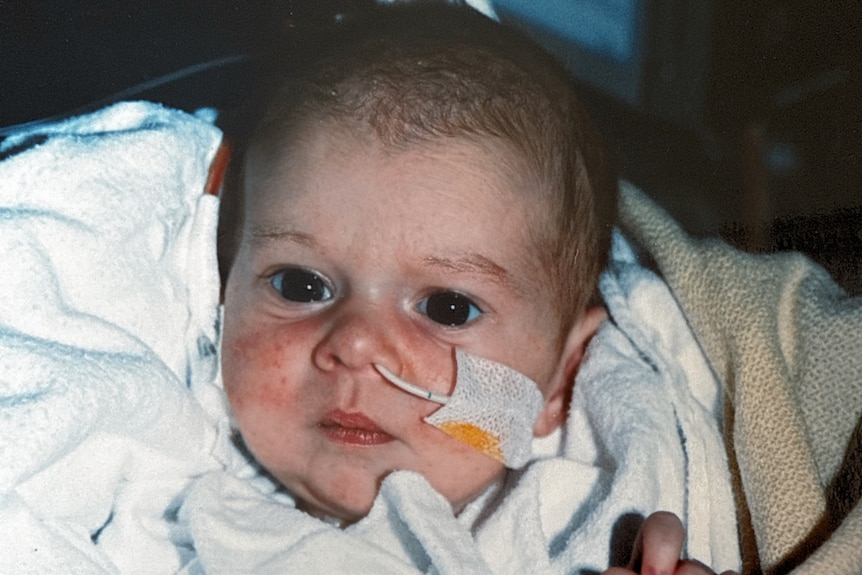A child with an oxygen line in his nose.